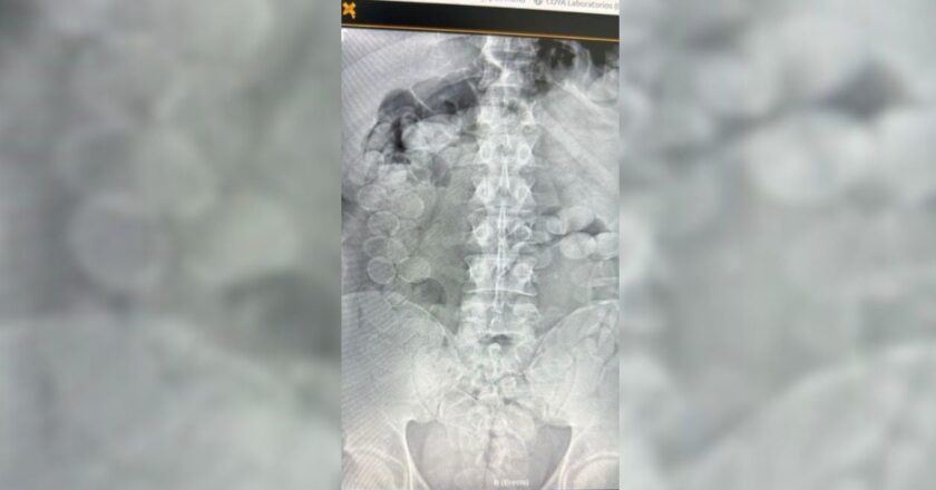 Ceres: detienen a dos mulas con 180 cápsulas de cocaína en sus cuerpos